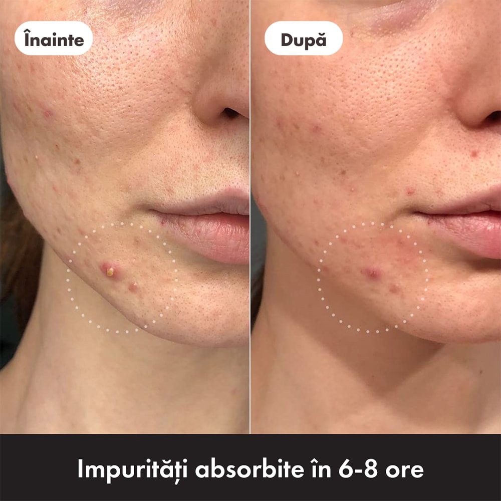 Plasturi Anti Acnee HERO Mighty Patch Duo, 12buc